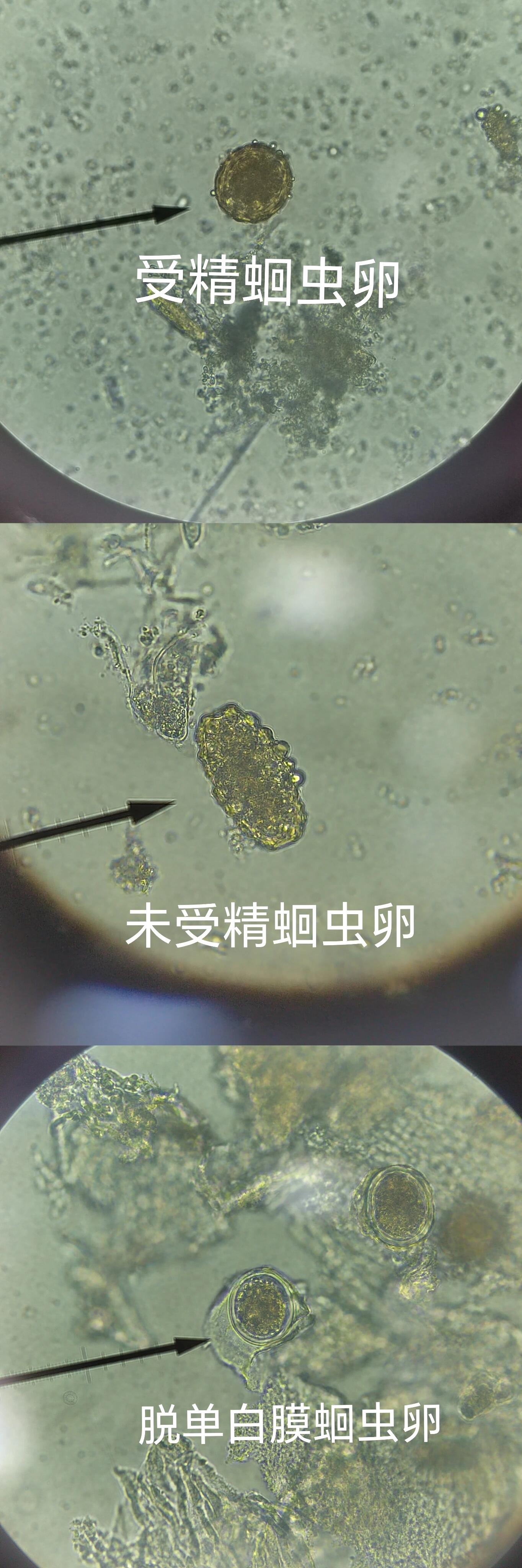 寄生虫卵——蛔虫卵吸虫卵