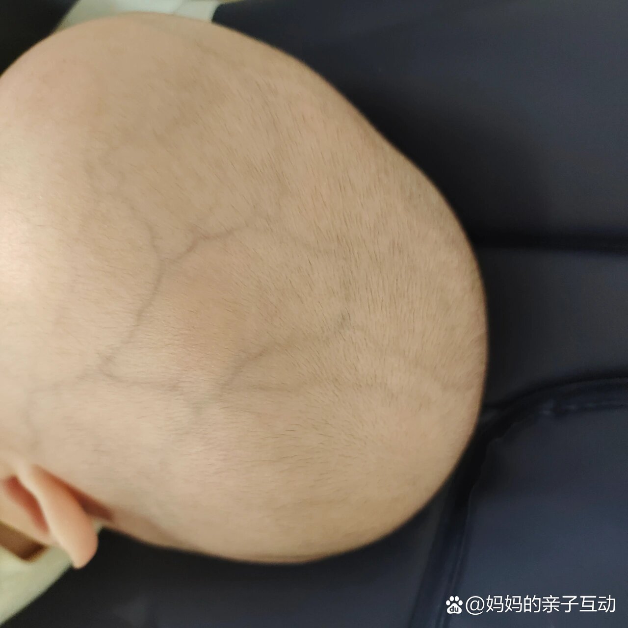 宝宝头上的青筋为什么这么明显