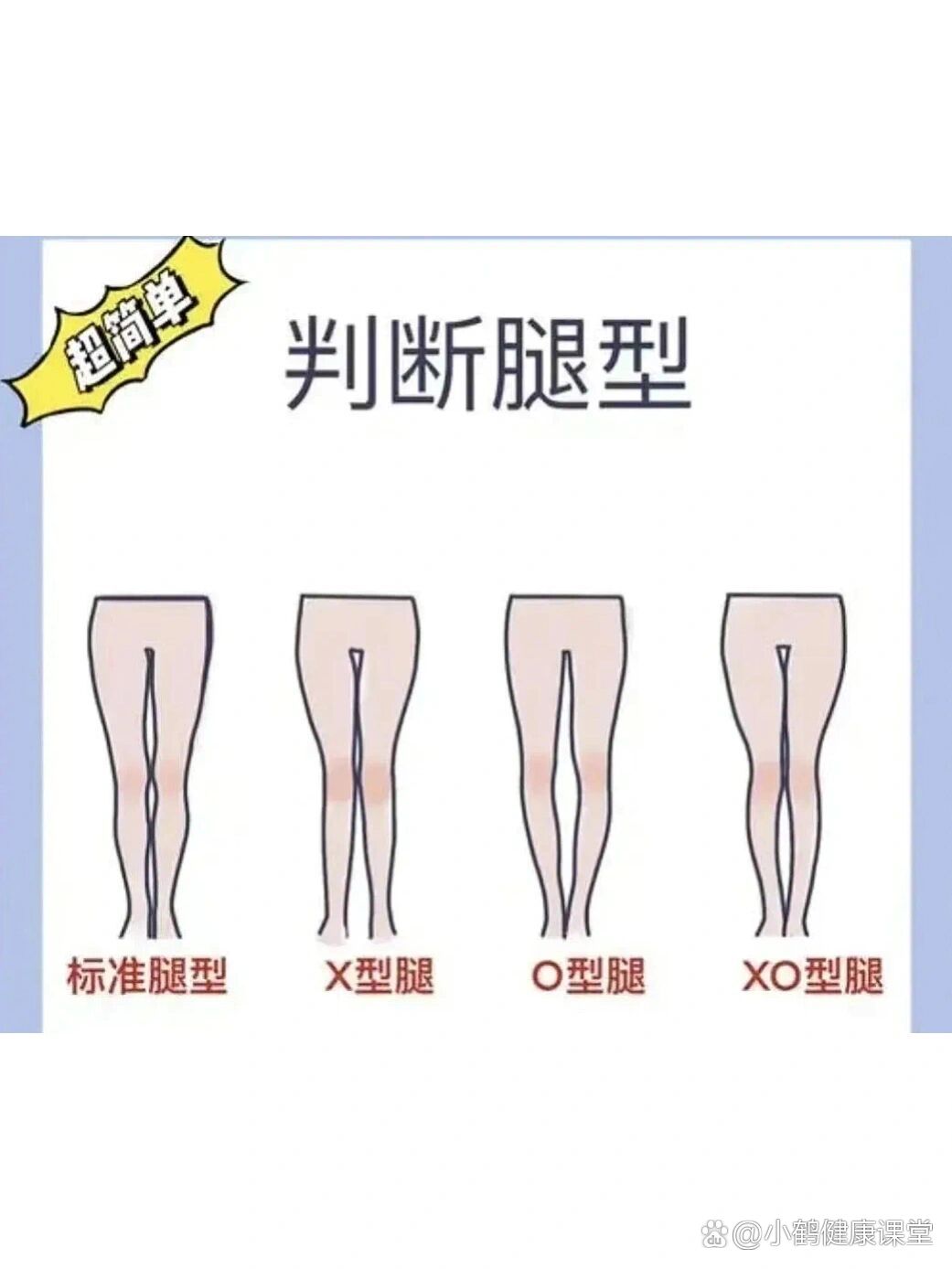 o型腿的原因图片