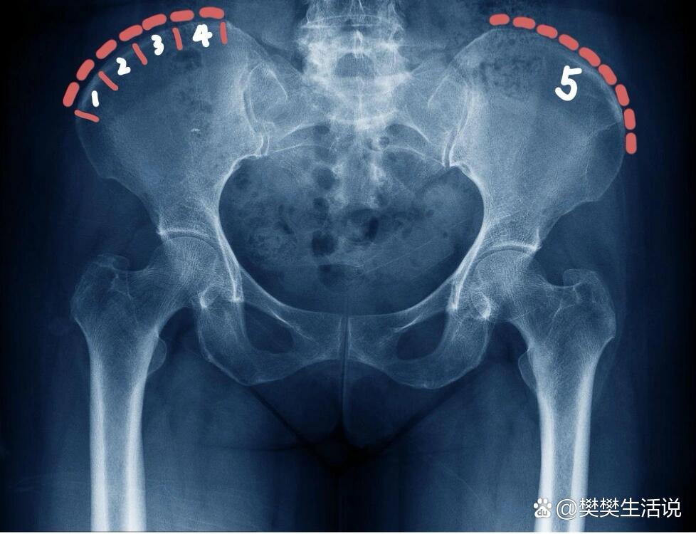 骨盆x光片怎么看骨龄?