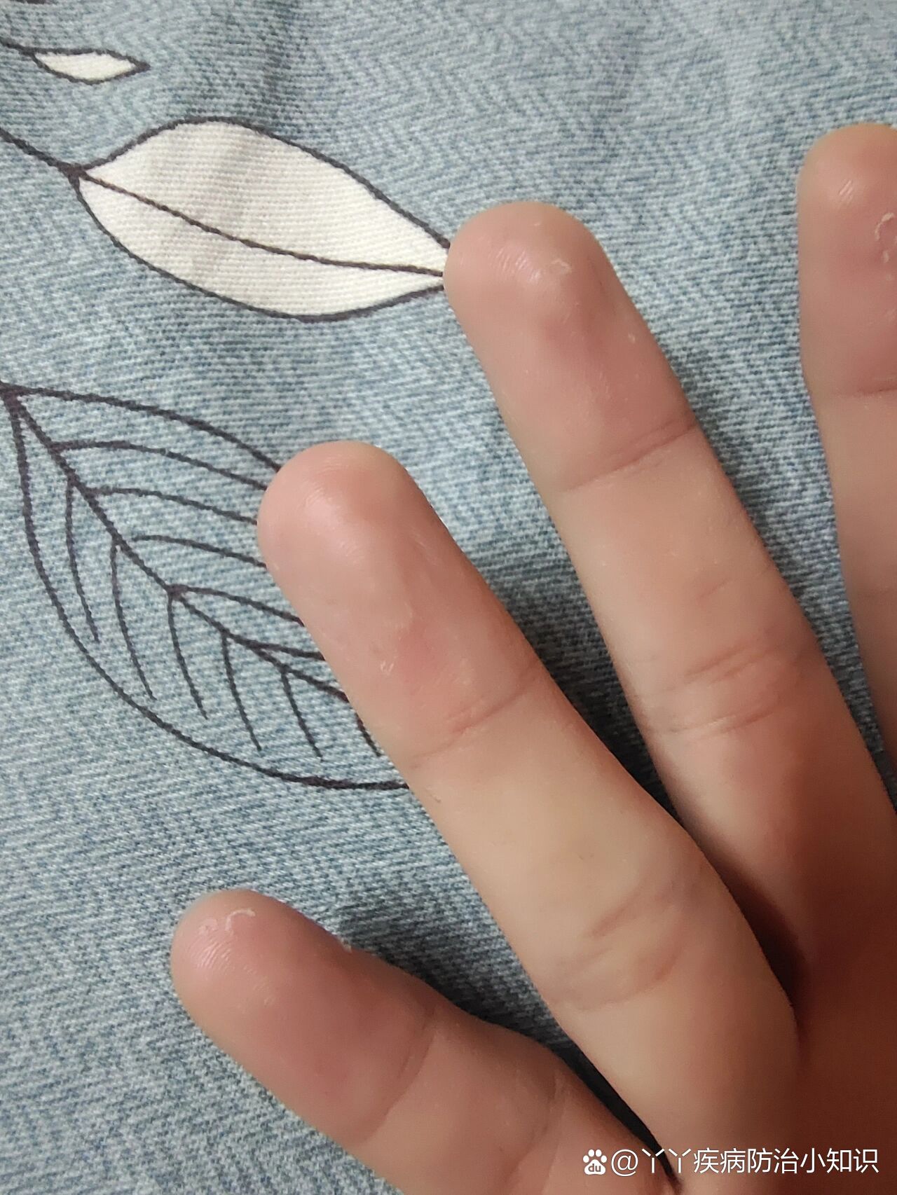 求助,手指头上有白色的小泡泡是怎么了