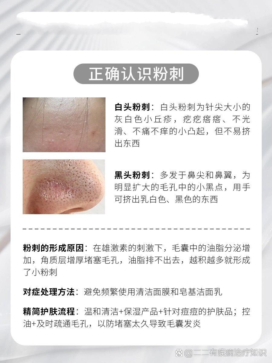 正确认识粉刺白头粉刺:白头粉刺为针尖大小的灰白