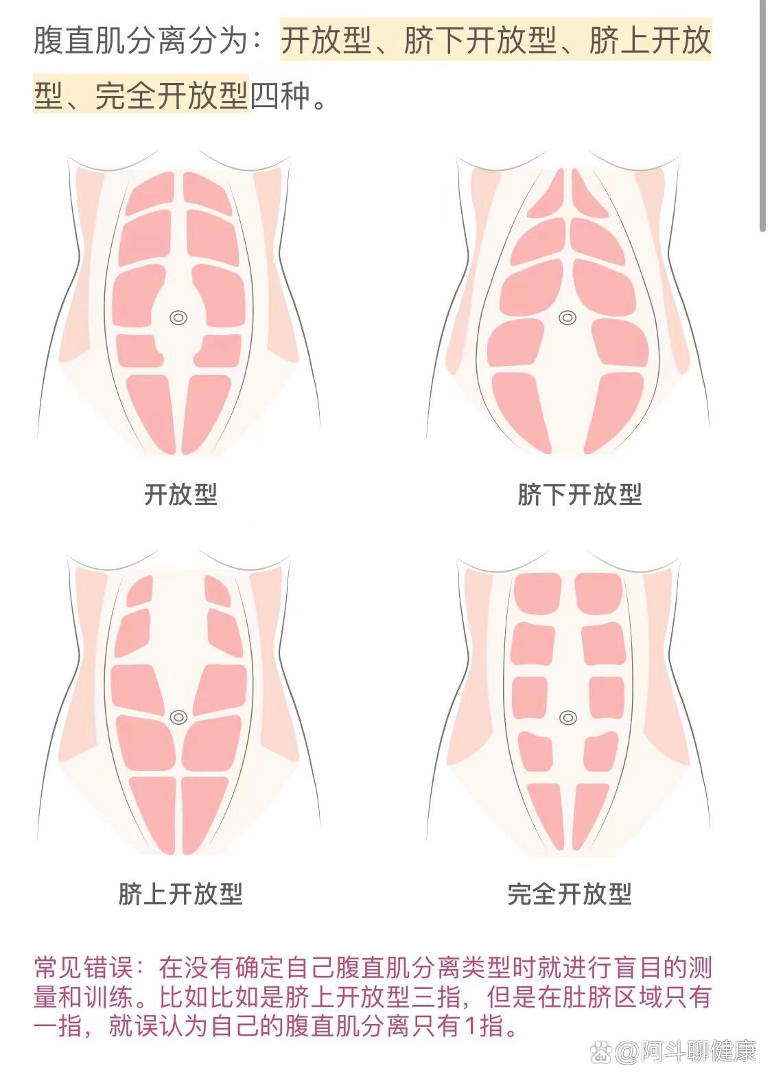 腹直肌分离自测图解图片