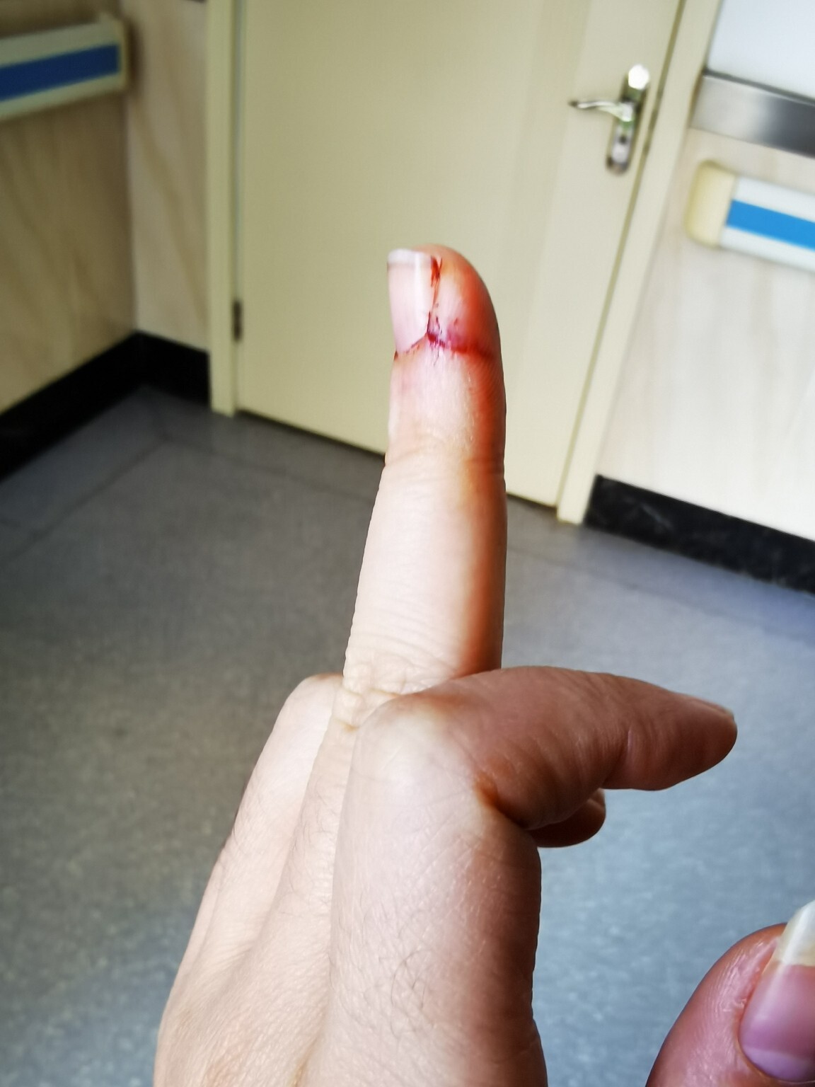 手指被菜刀切到了,不要慌,先来医院看一看