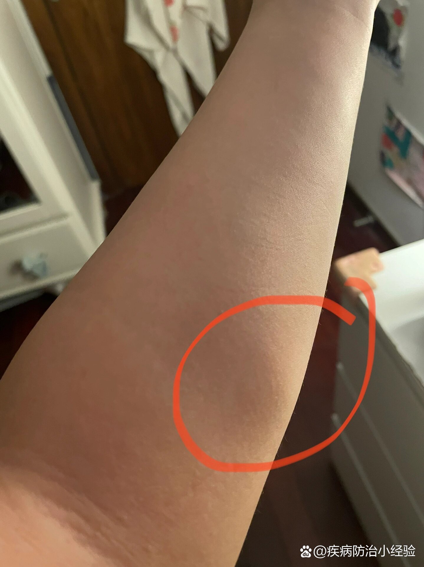 好害怕昨天睡午觉醒来 特别偶然的摸了一下手臂那个位置 摸到一个
