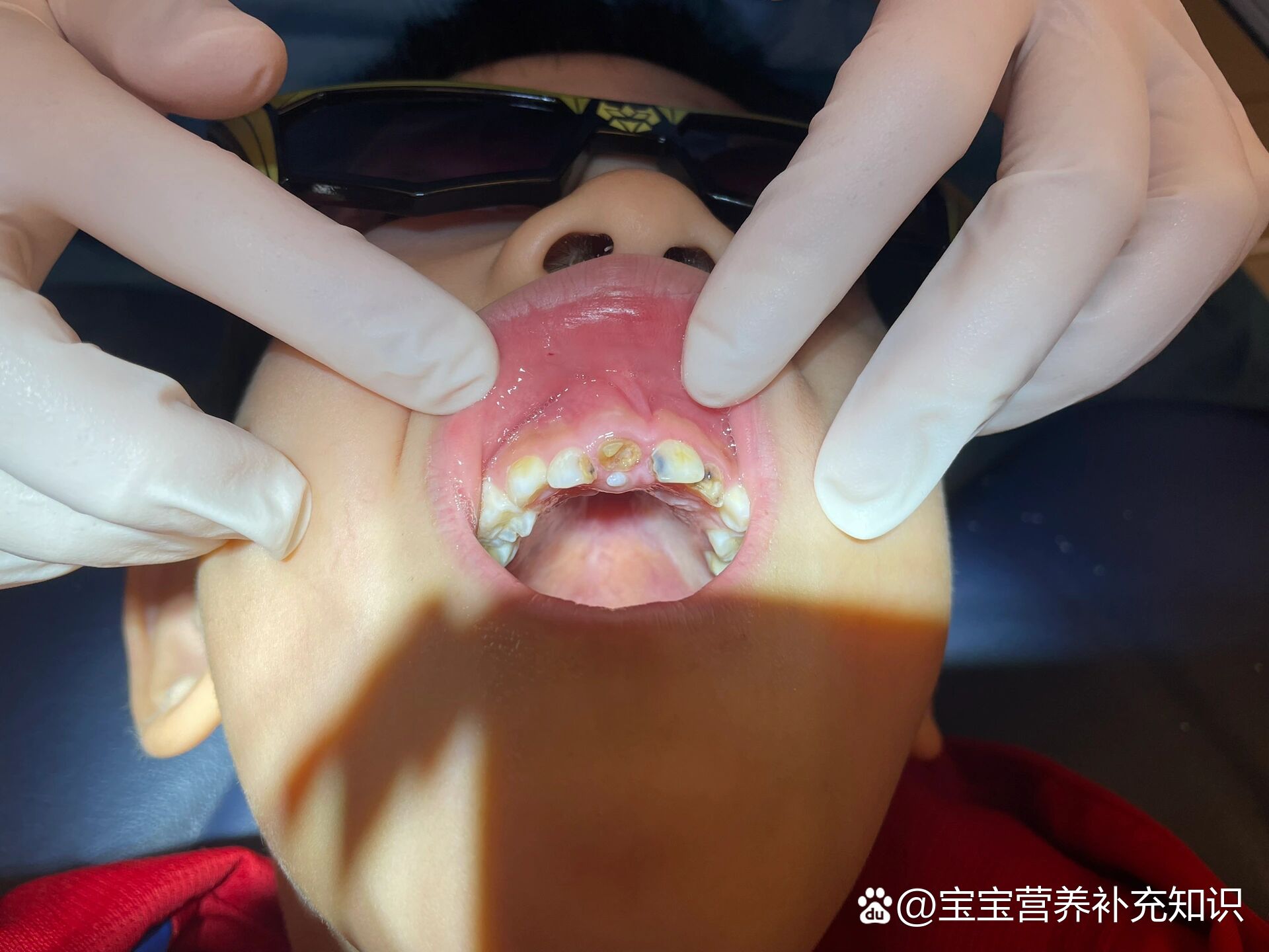 小朋友的多生牙🦷