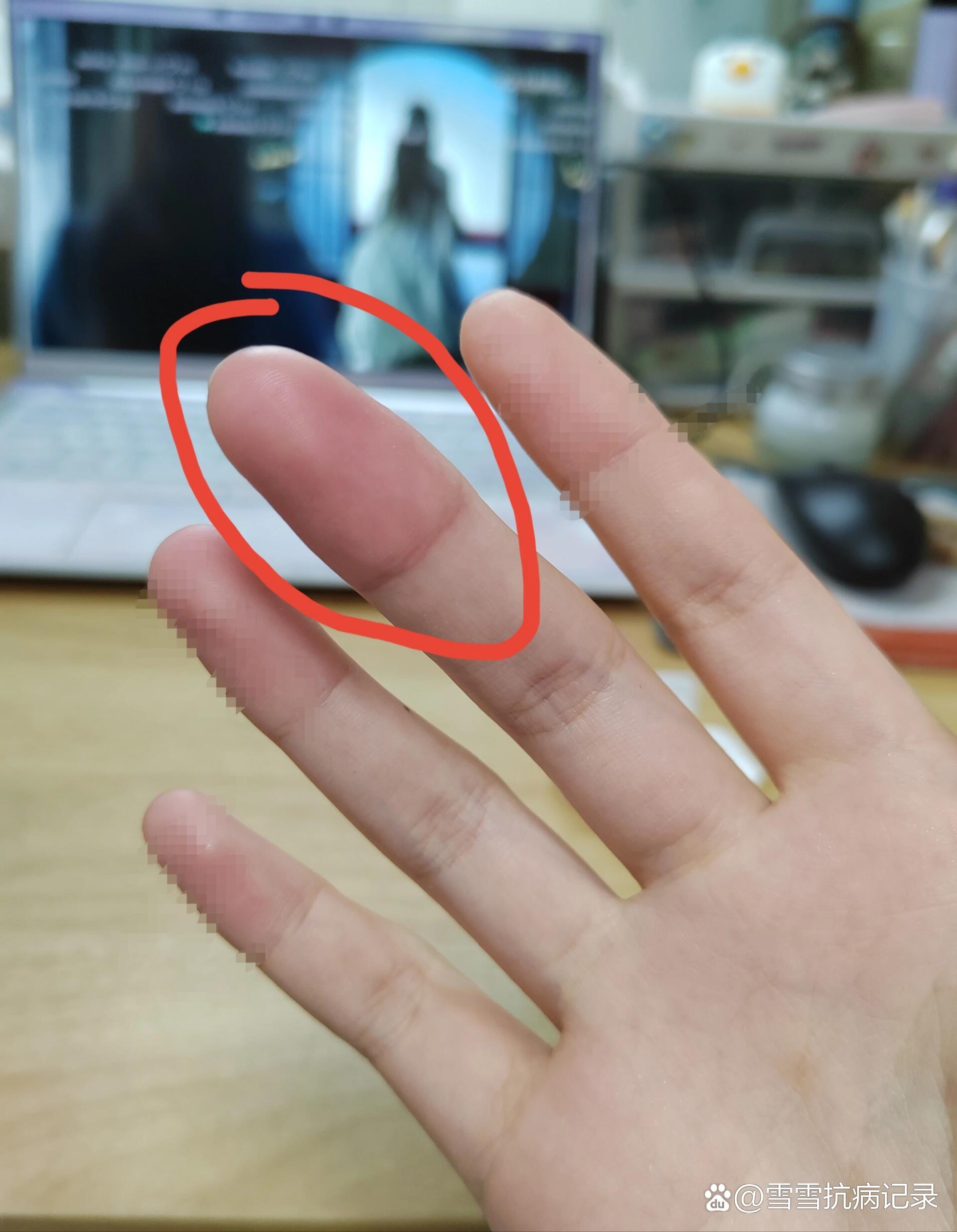 手指莫名其妙肿胀