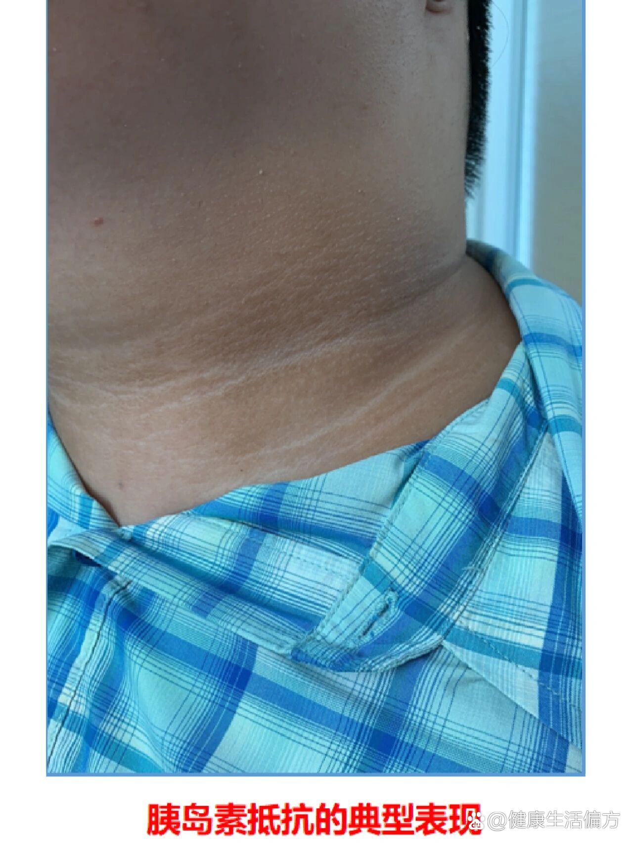 儿童肥胖之黑棘皮征