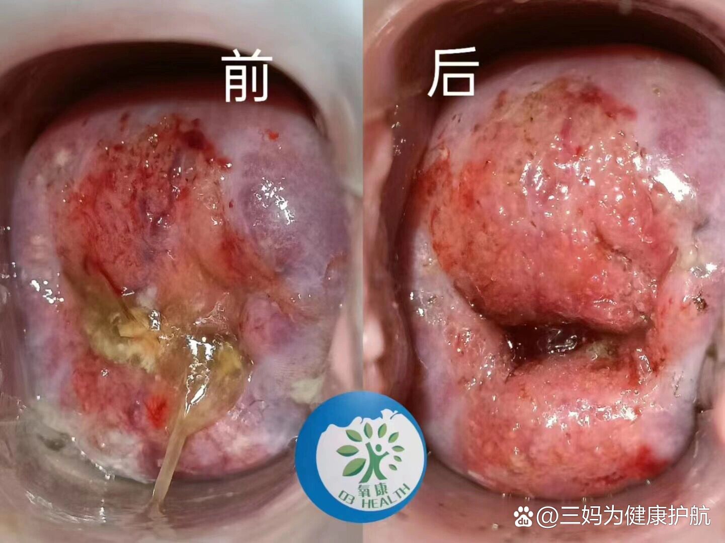 宫颈糜烂会自愈吗图片