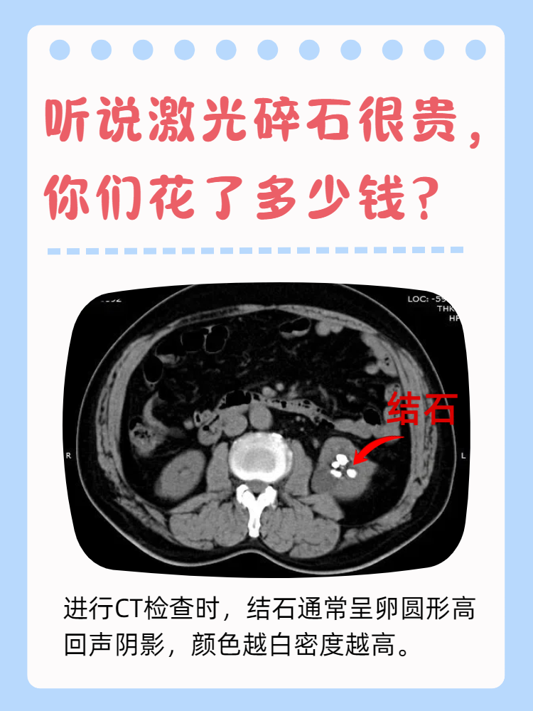 听说激光碎石很贵,你们花了多少钱?