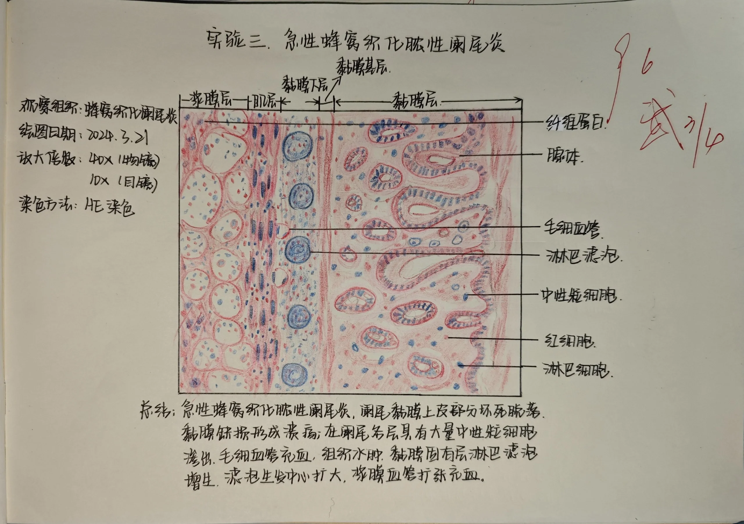 阑尾炎病理手绘图图片