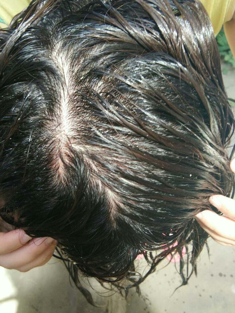 头皮出油居然跟这个有关,你中招了吗?