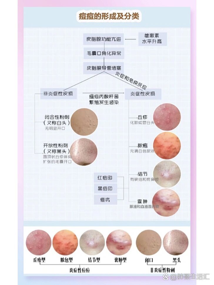 一分钟教你辨别你属于哪种痘痘类型(建议收