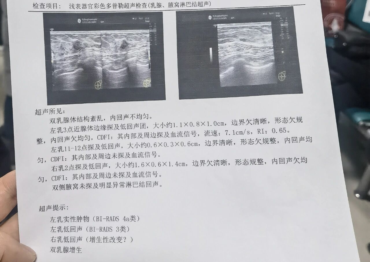 乳腺结节4a类严重吗图片