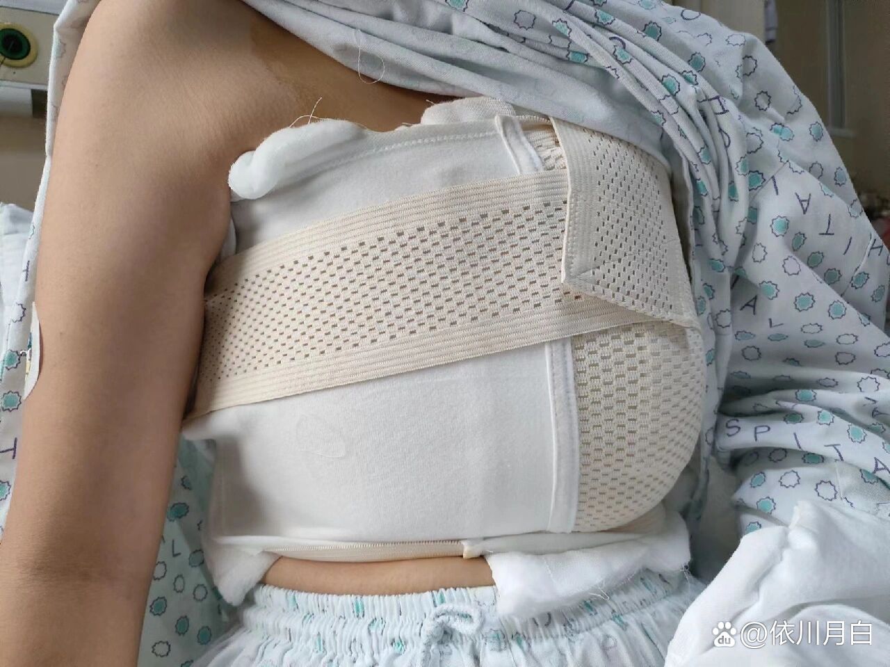 乳腺纤维瘤微创手术