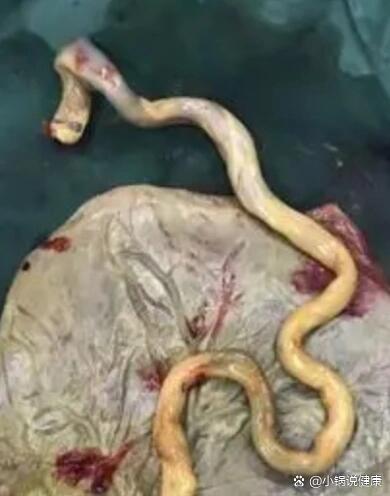羊水少三度粪染后悔顺产了