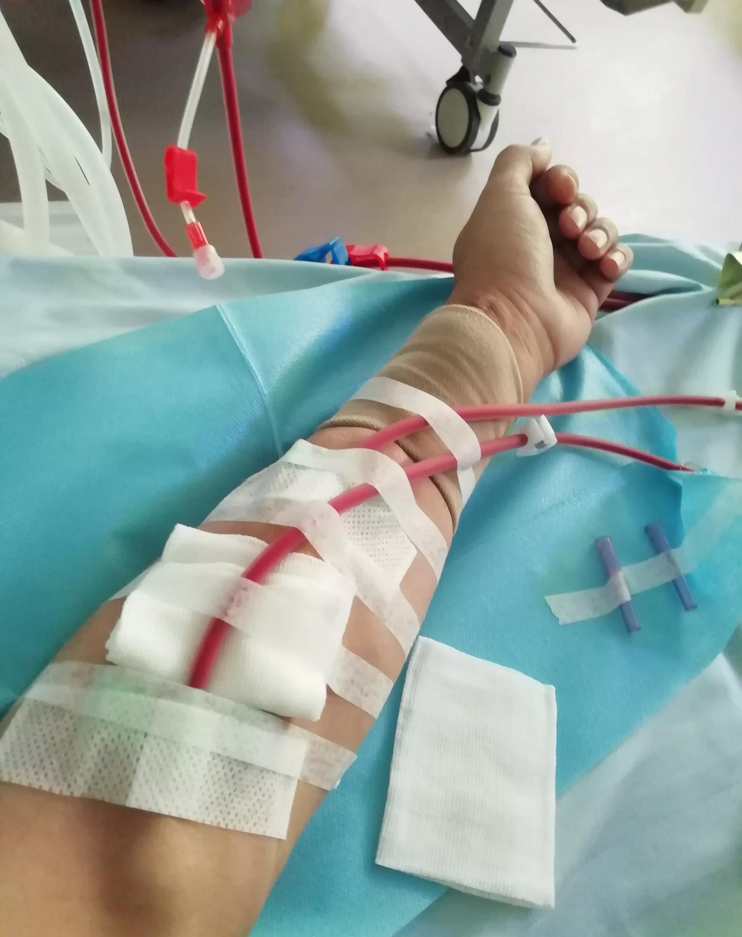 透析了11年的手臂,到处都是针眼,内瘘鼓包,不知道了是什么原因,难道是