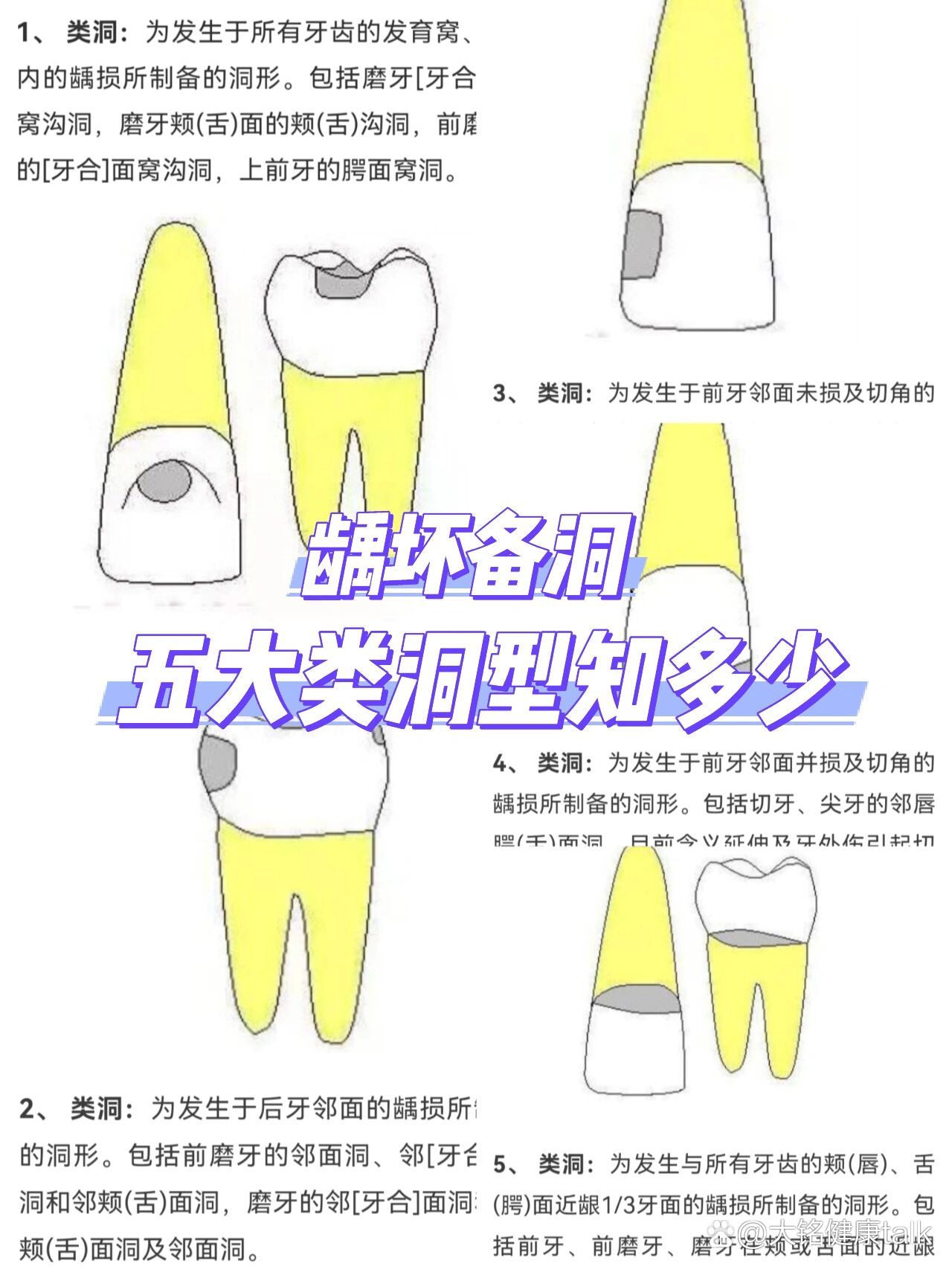 口腔二类洞鸠尾制备图片