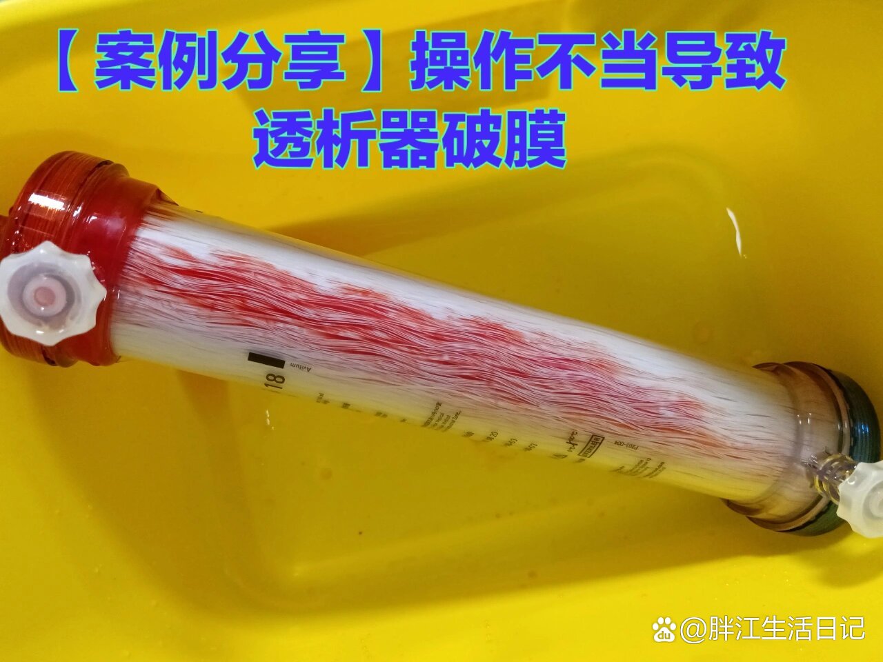 【案例分享】操作不当导致透析器破膜