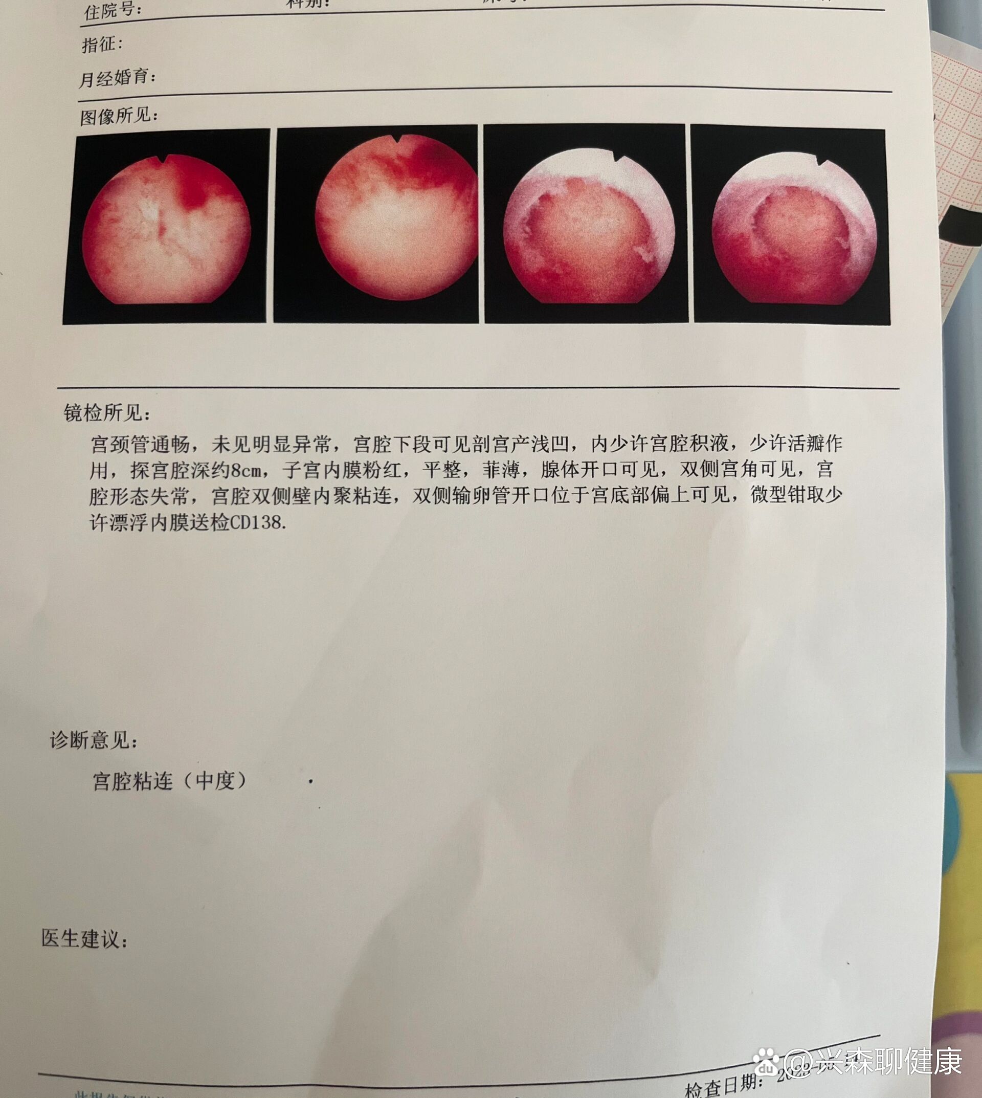 中度宫腔粘连8分