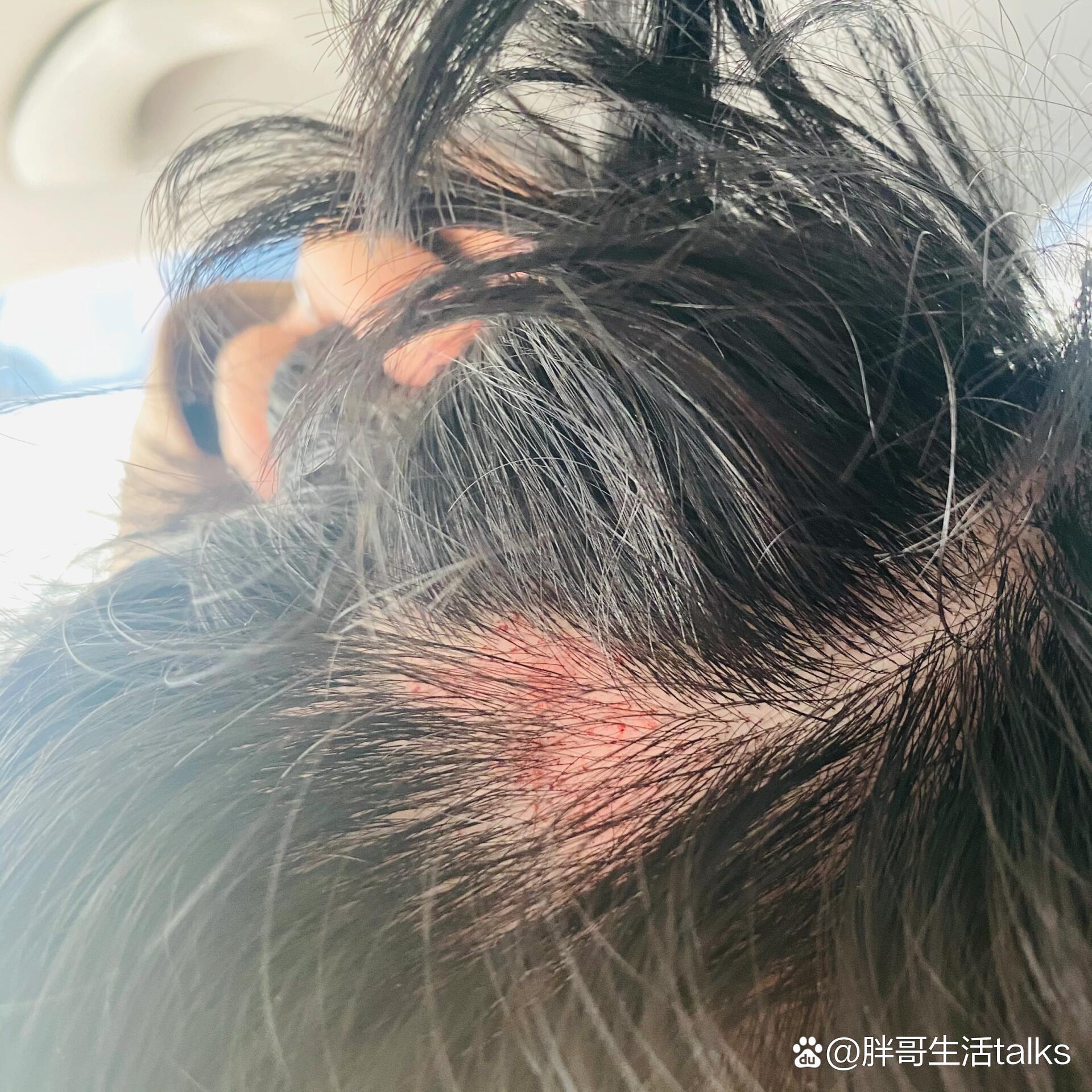  p>头发被薅了 br>打架头发被薅了要怎么办啊 /p>
