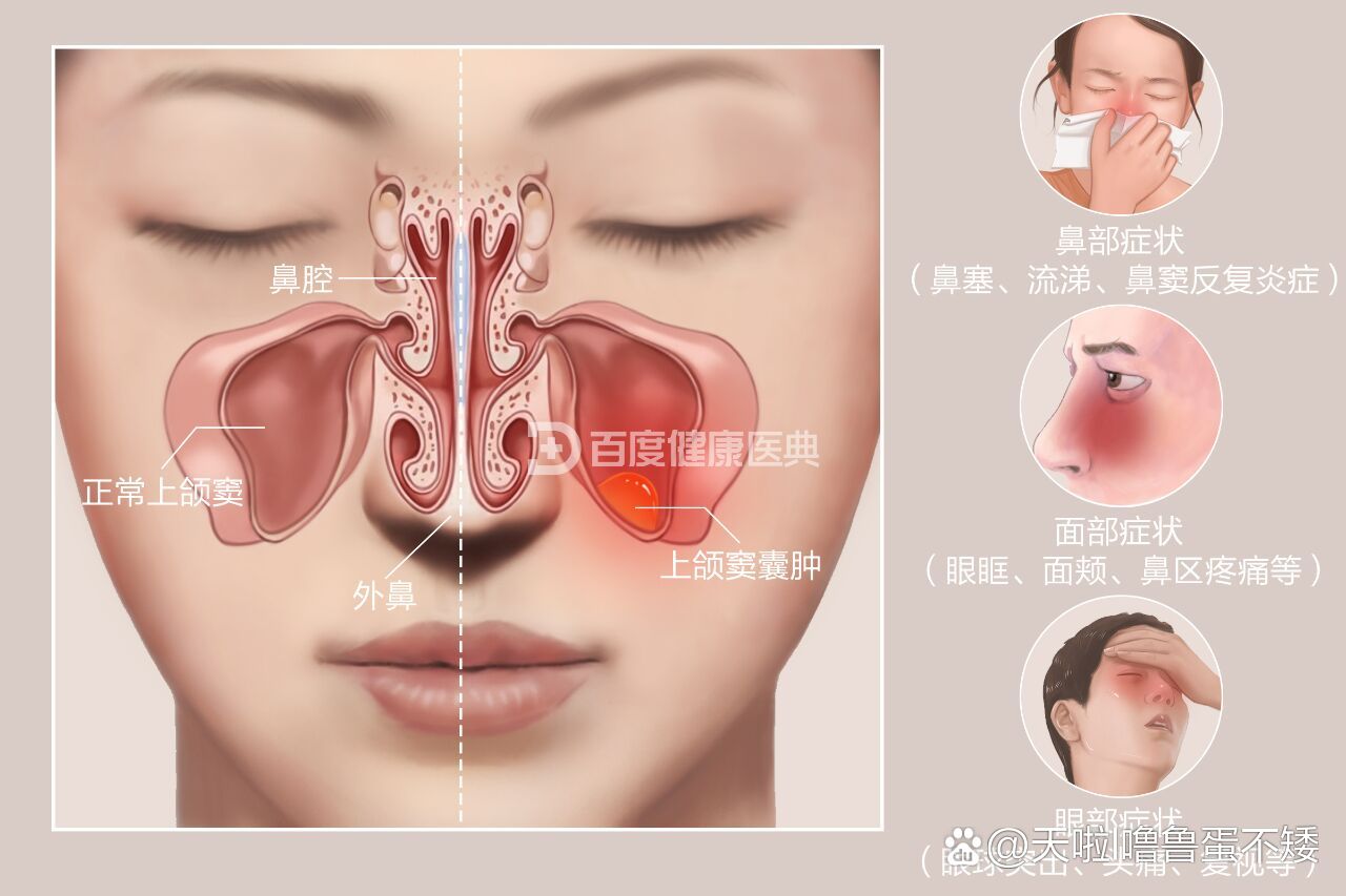 典型症状 br>	 br>早期囊肿较小时,无明显临床症状,当囊肿自行破裂可