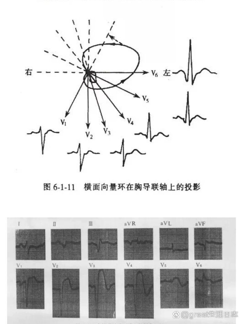 各型冠心病的心电图鉴别诊断