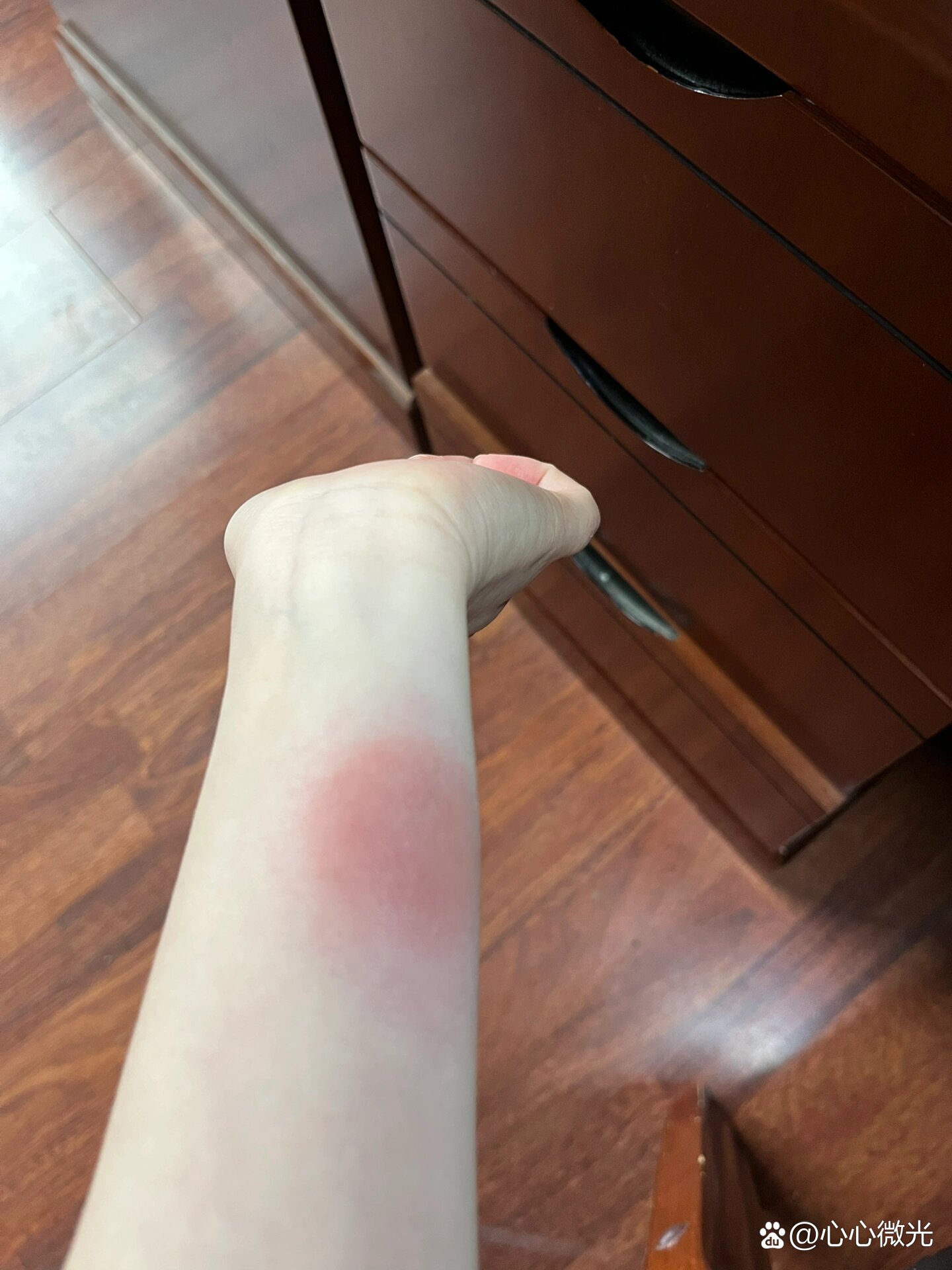 破伤风皮试过敏了怎么办