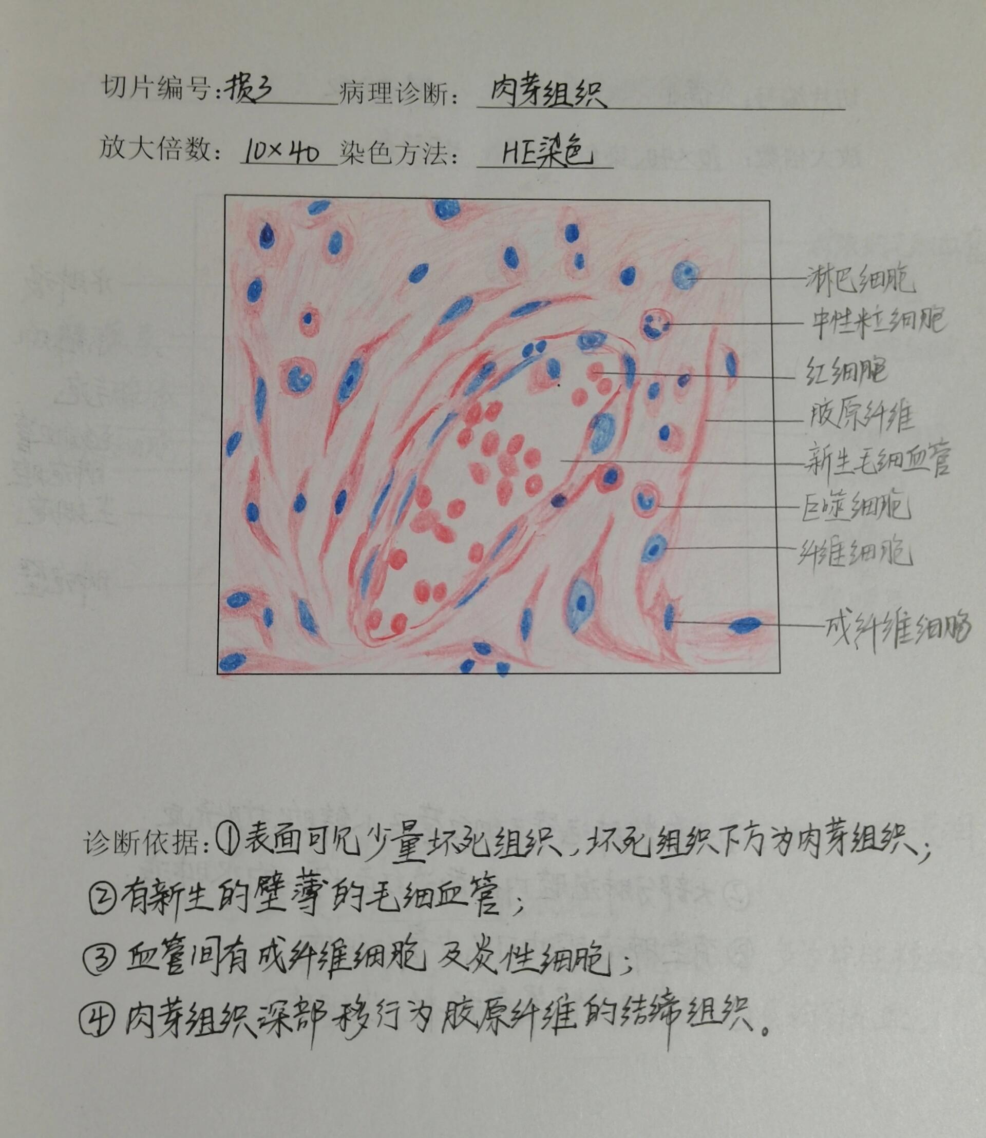 病理实验阑尾炎手绘图图片