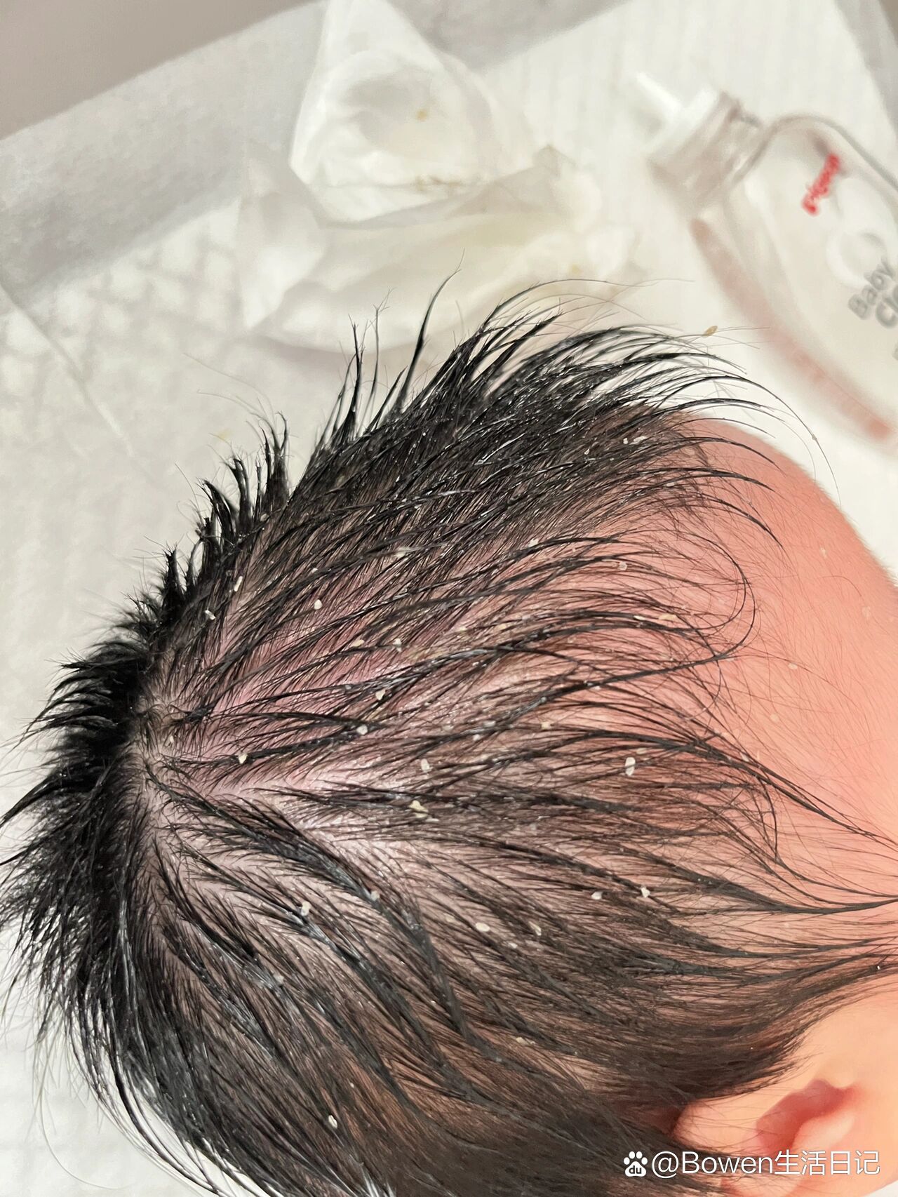 宝宝脂溢性皮炎一招就干净