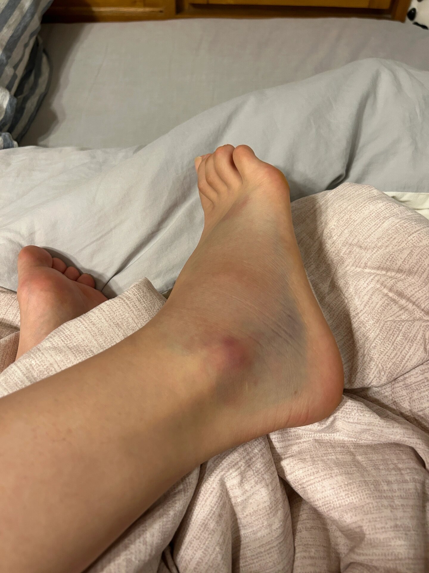 脚踝扭伤不完全攻略(自愈版)崴脚千万严肃认真!别不当回事!