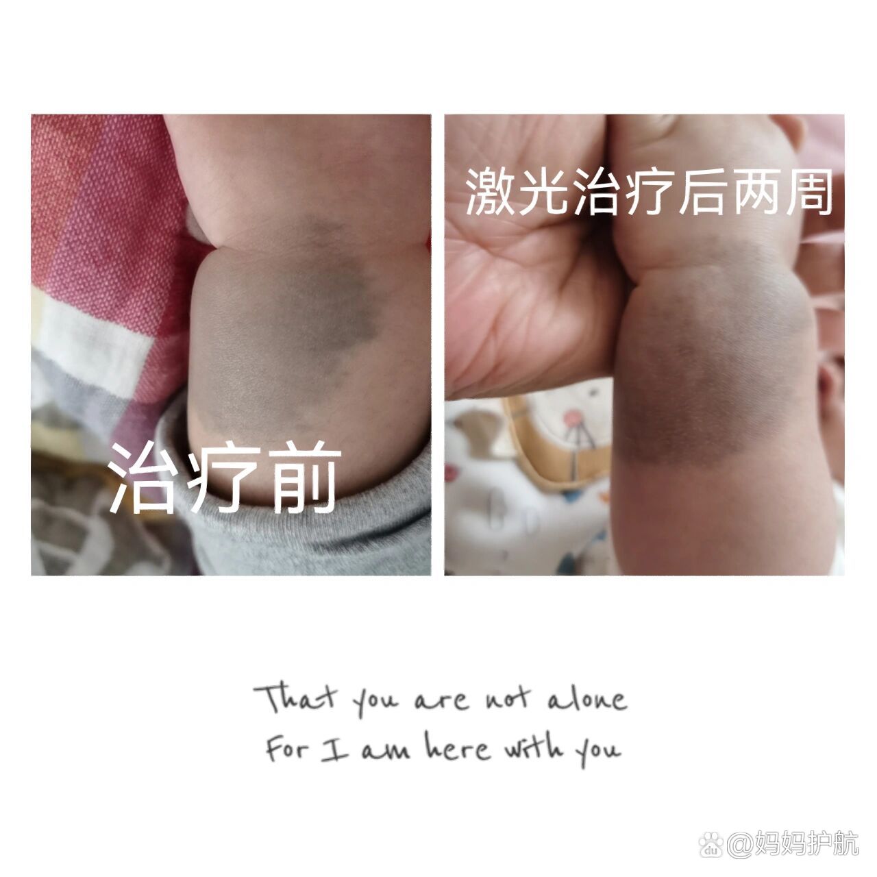 儿研所激光治疗新生儿胎记