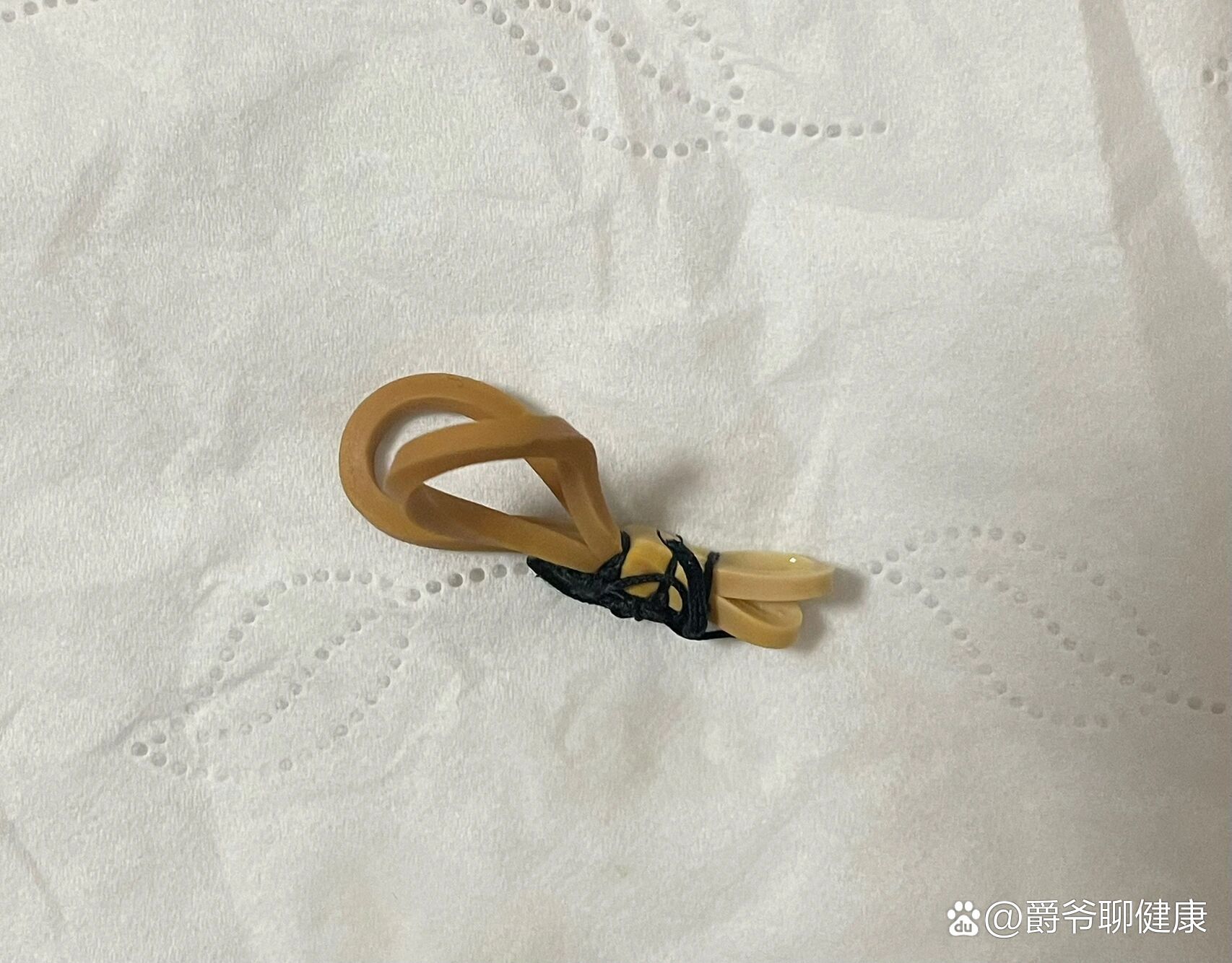 肛周脓肿橡皮筋挂线图图片