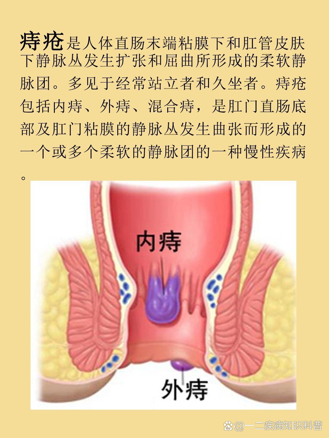 男性外痔图片大全图片