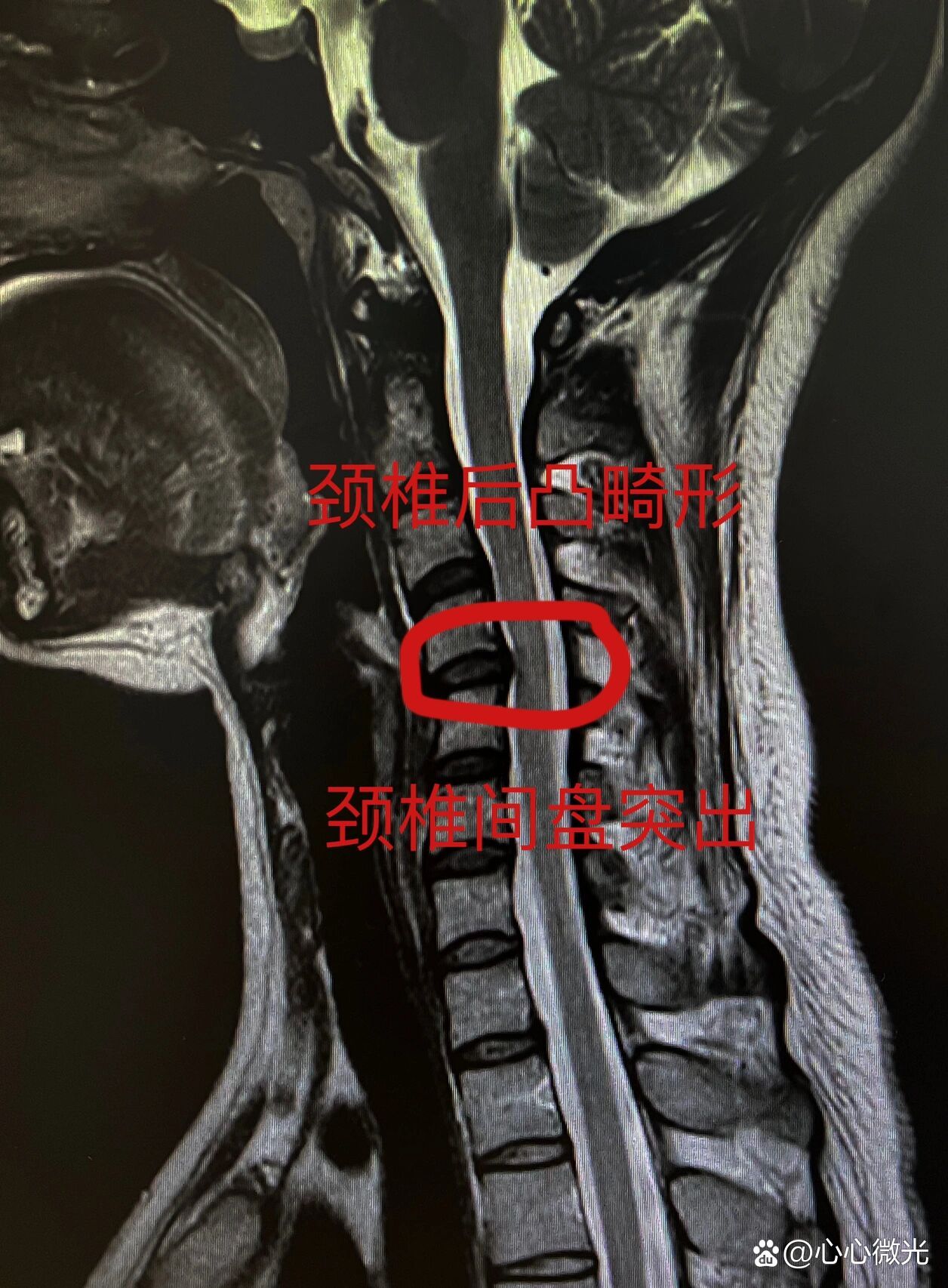 年轻人颈椎后凸导致椎间盘突出的治疗策略
