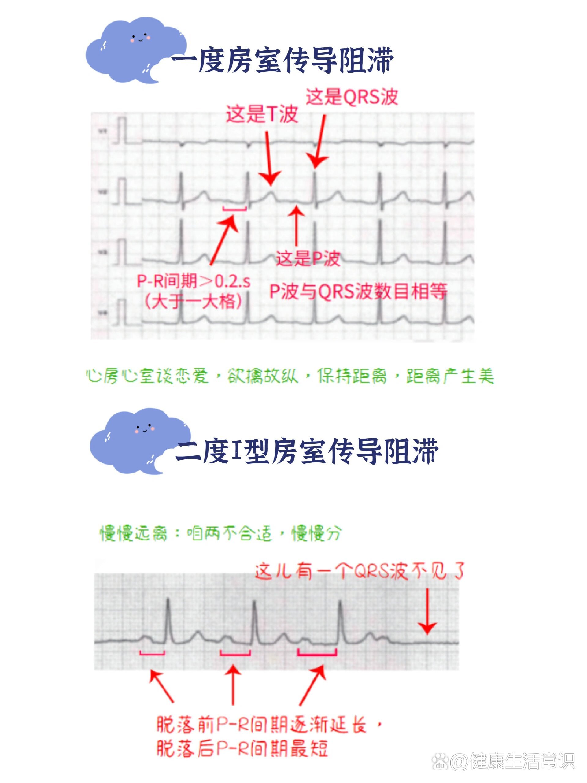 学霸都在看的超全心电图总结