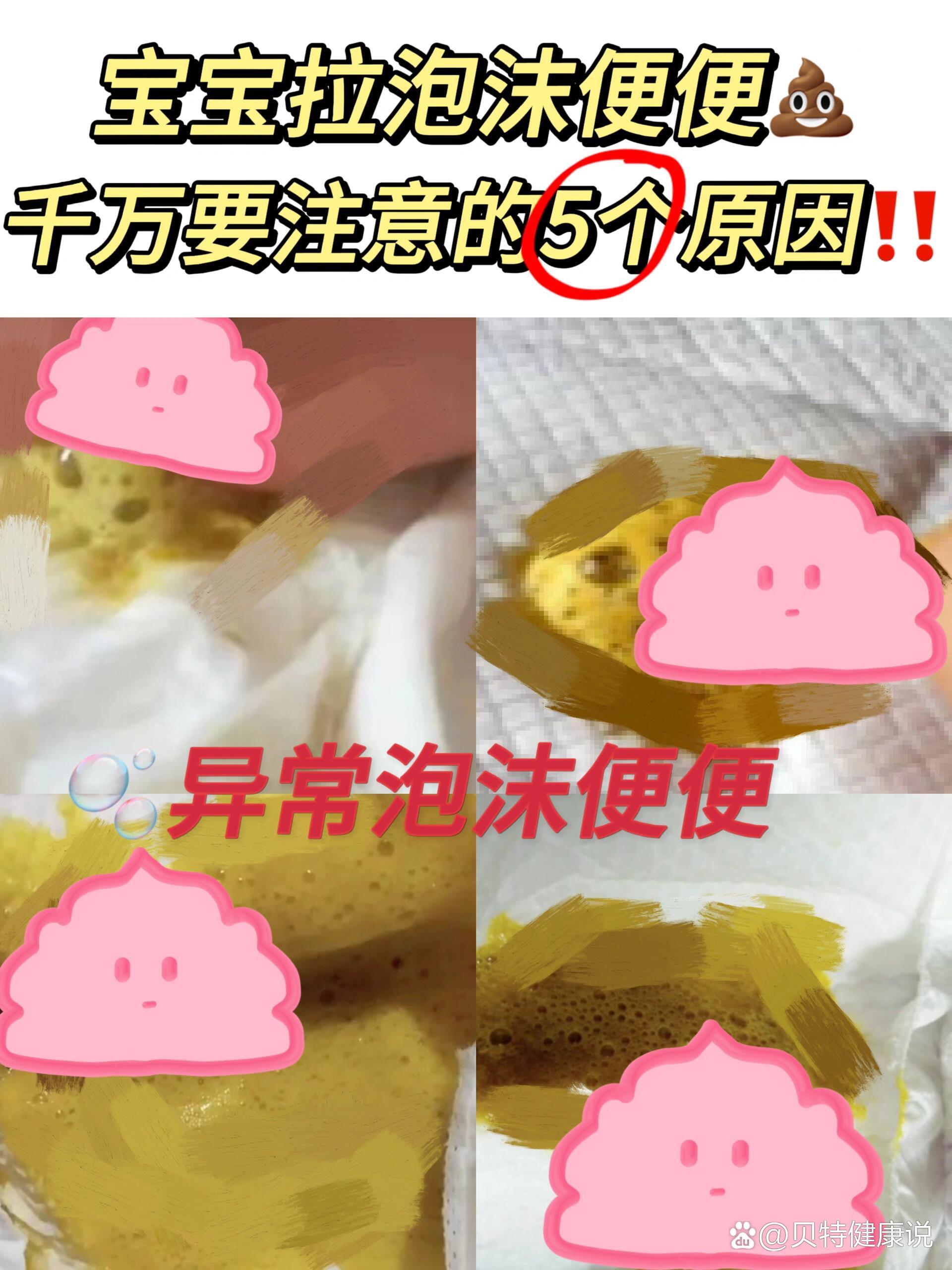 当心这5个原因73 br>泡沫便便也是宝宝常见的异常便便情况中的一种
