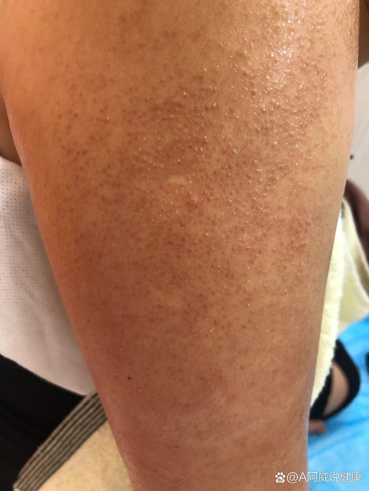 毛周角化,药店买点药膏绝对能改善90%