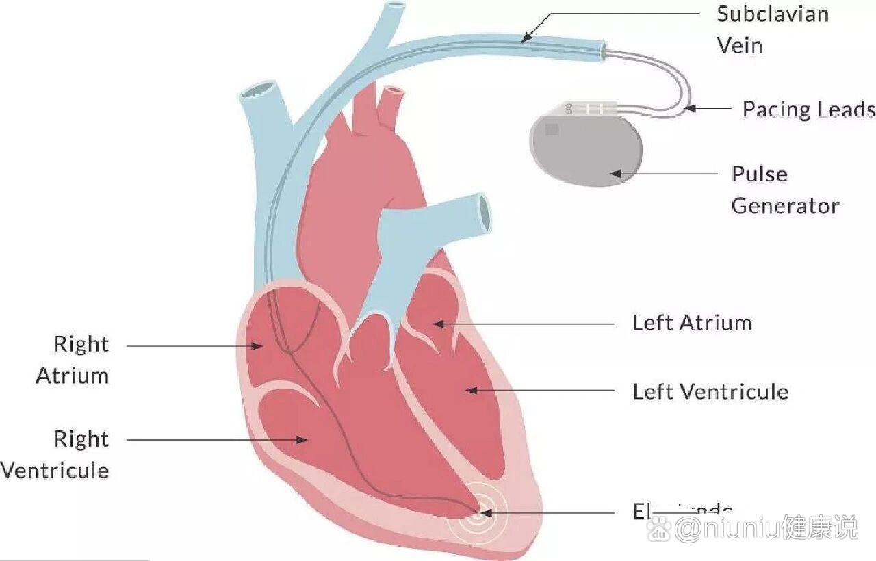 心脏起搏器多大图片图片