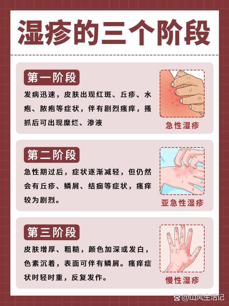 湿疹大作战94,你需要知道的都在这啦!