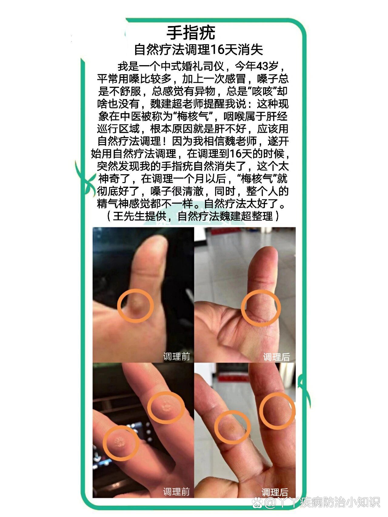手指疣自然疗法康复案例