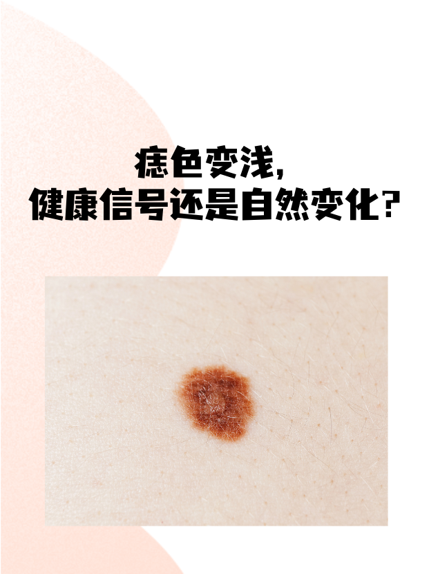 下面,就让我们一起探讨痣颜色变浅背后的秘密以及我们应该如何应对.