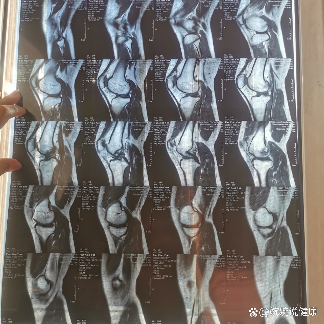 有人愿意给我看看膝盖核磁麽