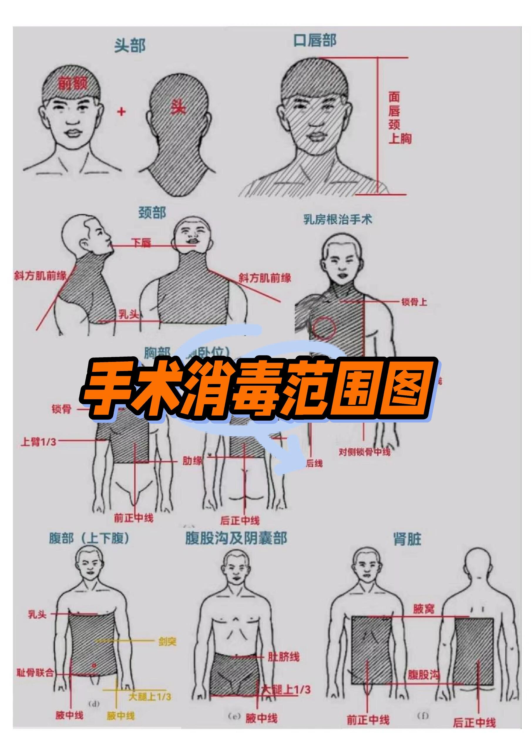 手术消毒范围图