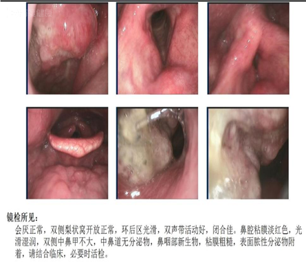 鼻咽部非角化性鳞状细胞癌,放疗改善症状