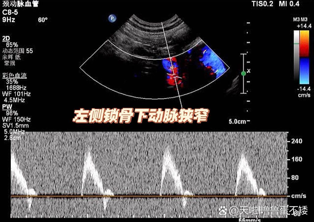 锁骨下动脉ct图片