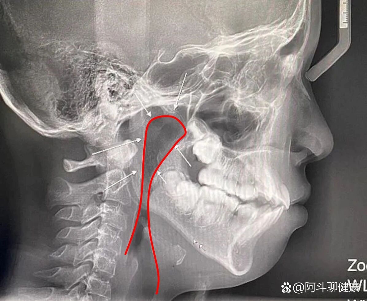 腭扁桃体ct图片