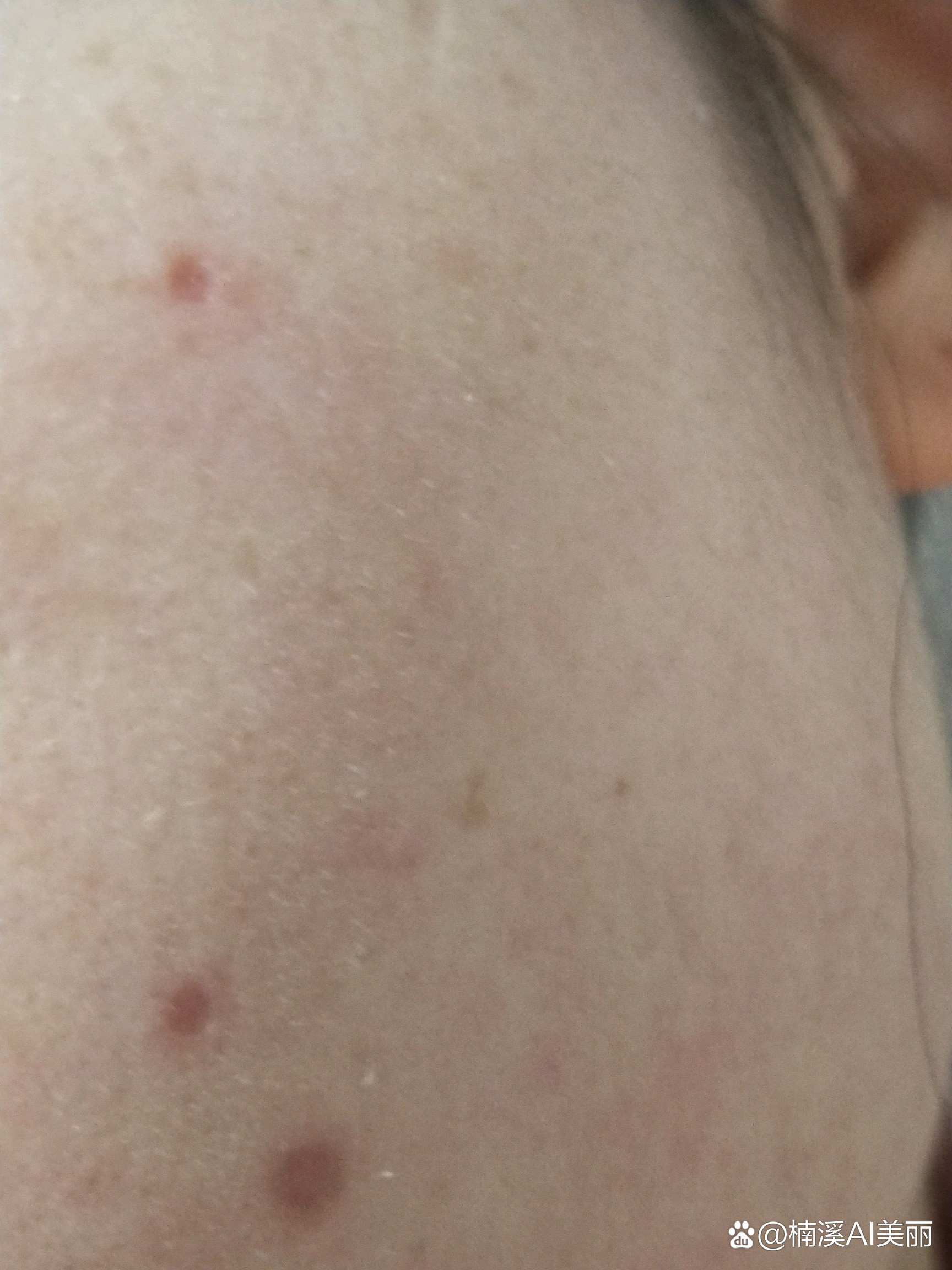 激光点痣不小心把结痂碰掉了,怎么处理?