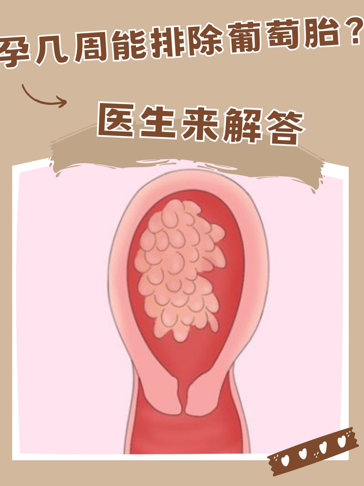 孕几周能排除葡萄胎?医生来解答