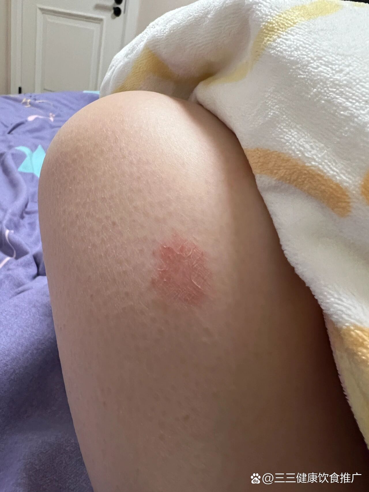 冬天突然一个大腿上出现了一块斑,皮肤干裂疼痛怎么回事